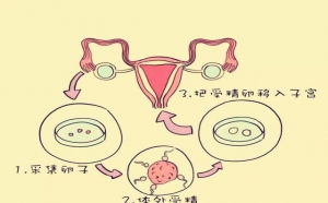 一代试管移植流程是怎样的？费用大概是多少-第一代试管婴儿百科