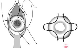 2023年多囊女性想做深圳三代试管选男孩大概需要多少钱呢？