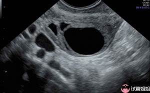 在线咨询女性宫腔有积液做广州三代试管婴儿还能成功吗？