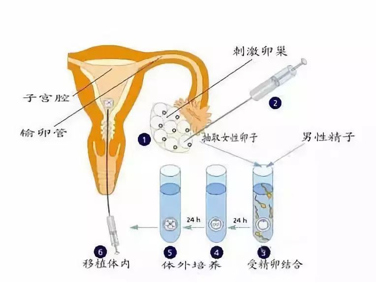 一代试管和二代试管的区别