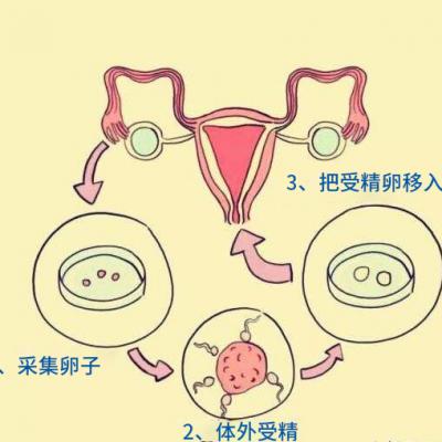 试管婴儿做一次多少钱，我们应该如何备孕？