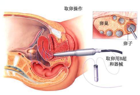 做试管婴儿女人受罪吗