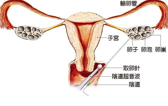 试管取卵痛吗？试管婴儿是一个怎么样的技术？