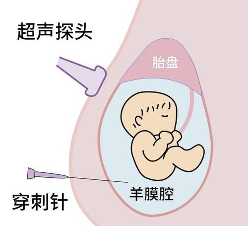 三代试管羊水穿刺通过率